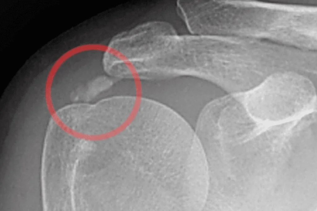 Shoulder Conditions-Cyprus Orthopaedics