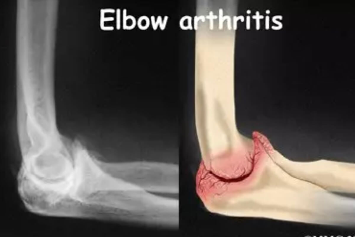 Elbow Conditions-Cyprus Orthopaedics