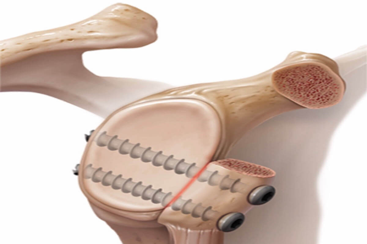 Shoulder Procedures-Cyprus Orthopaedics