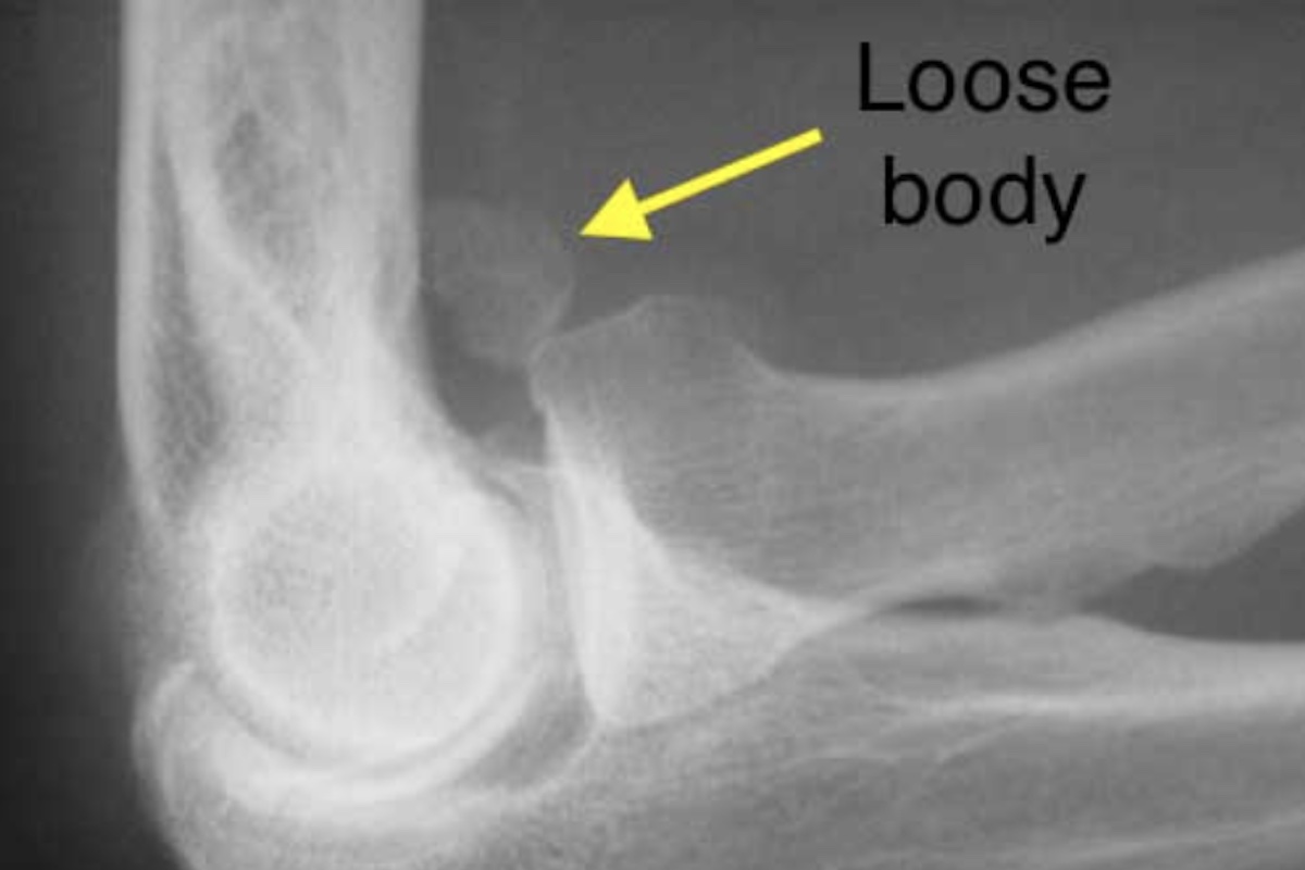 Elbow Conditions-Cyprus Orthopaedics