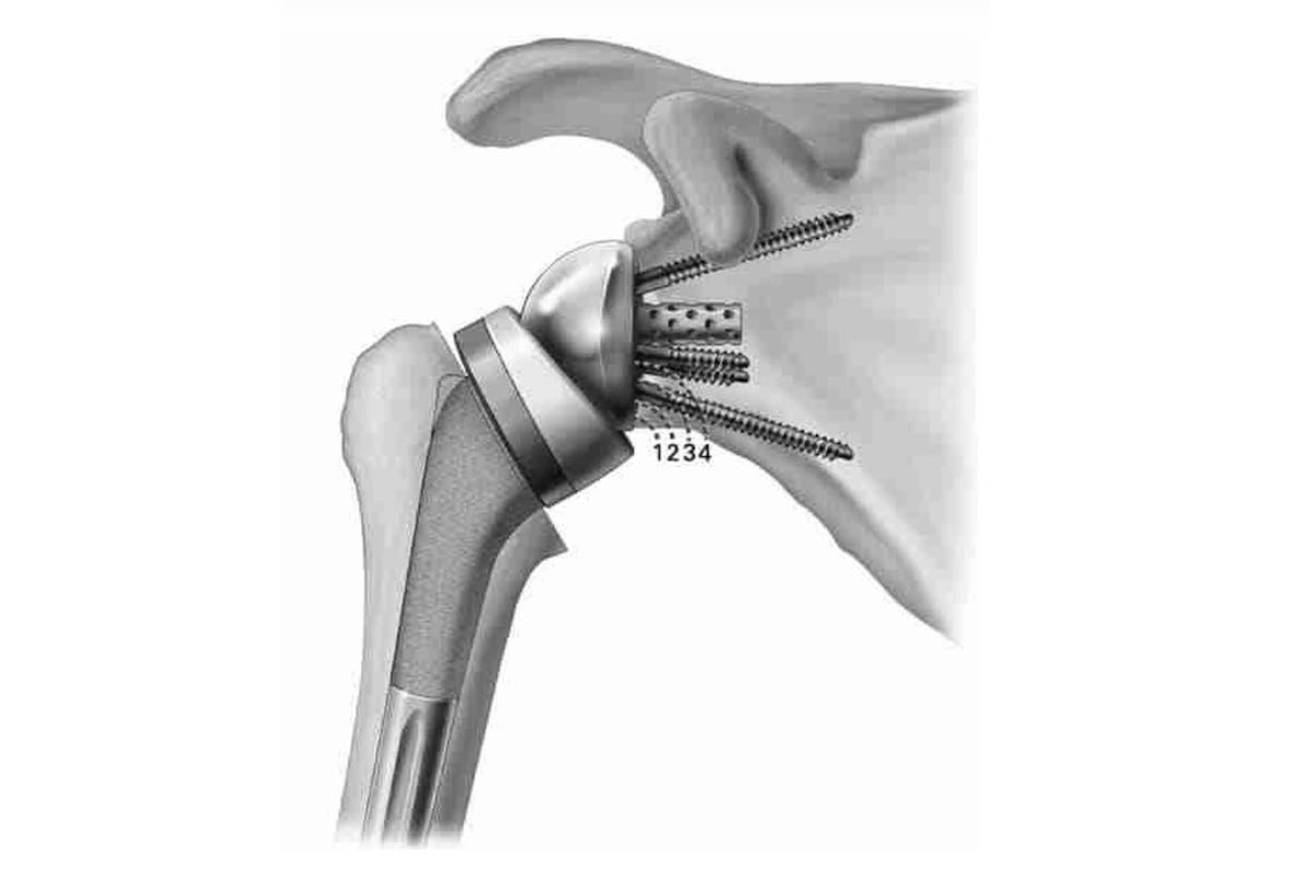 Shoulder Procedures-Cyprus Orthopaedics