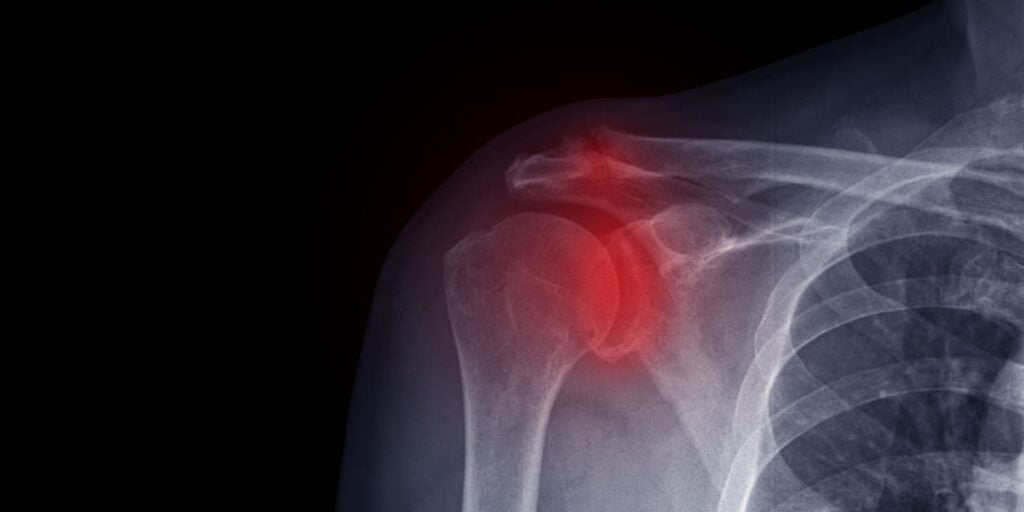 Arthritis of acromioclavicular joint