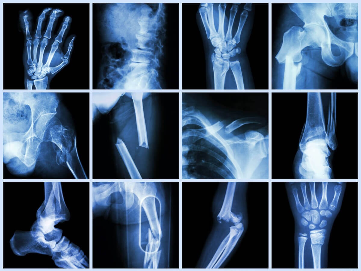 arthritis mix